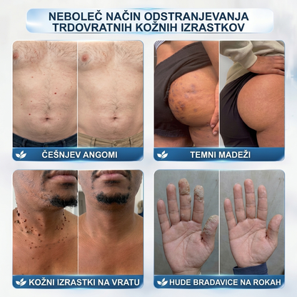 💎Uradna trgovina|✅️👩‍⚕️𝐇𝐈𝐒𝐊𝐈𝐍®7 dnevni odstranjevalec kožnih izrastkov in madežev(𝐫𝐨𝐥𝐥-𝐨𝐧 𝐚𝐩𝐥𝐢𝐤𝐚𝐭𝐨𝐫: 𝐛𝐫𝐞𝐳 𝐛𝐨𝐥𝐞č𝐢𝐧 𝐢𝐧 𝐛𝐫𝐚𝐳𝐠𝐨𝐭𝐢𝐧)🌳