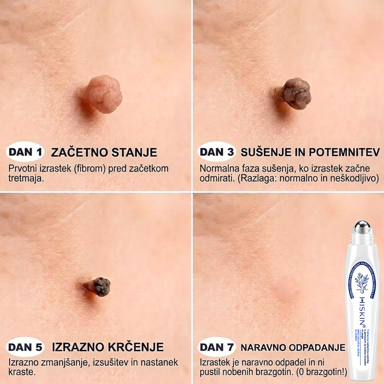 💎Uradna trgovina|✅️👩‍⚕️𝐇𝐈𝐒𝐊𝐈𝐍®7 dnevni odstranjevalec kožnih izrastkov in madežev(𝐫𝐨𝐥𝐥-𝐨𝐧 𝐚𝐩𝐥𝐢𝐤𝐚𝐭𝐨𝐫: 𝐛𝐫𝐞𝐳 𝐛𝐨𝐥𝐞č𝐢𝐧 𝐢𝐧 𝐛𝐫𝐚𝐳𝐠𝐨𝐭𝐢𝐧)🌳